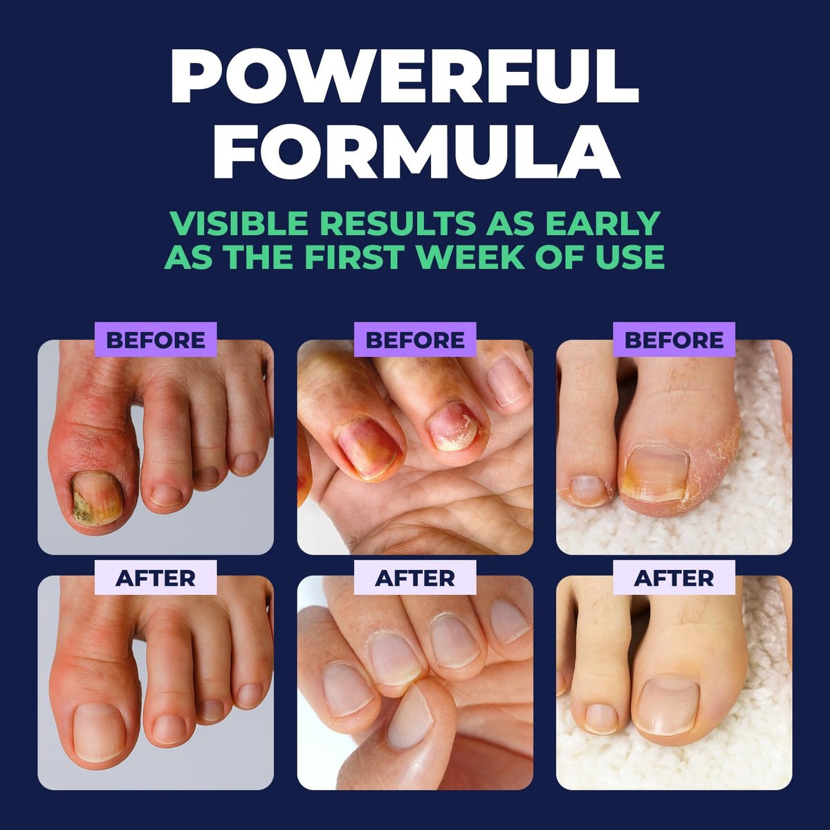Lminx Nail Care Pen – A Natural Way to Eliminate Nail Fungus - For Good
